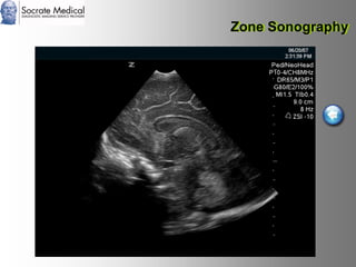 Socrate Medical presenta Zone Sonography, by Zonare