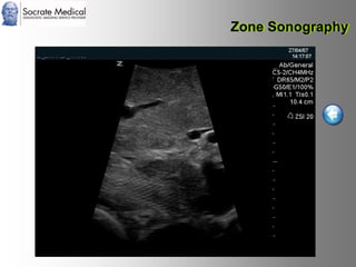 Socrate Medical presenta Zone Sonography, by Zonare