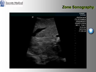 Socrate Medical presenta Zone Sonography, by Zonare
