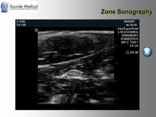 Socrate Medical presenta Zone Sonography, by Zonare