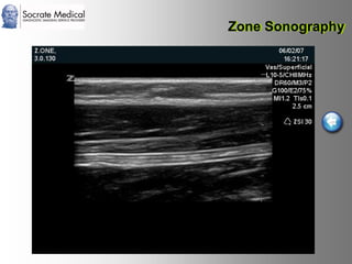 Socrate Medical presenta Zone Sonography, by Zonare