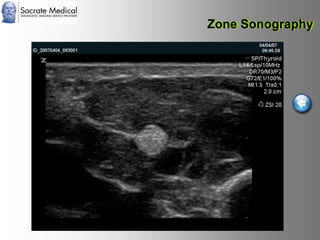 Socrate Medical presenta Zone Sonography, by Zonare