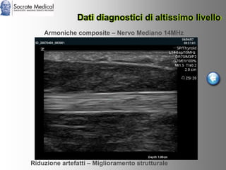 Socrate Medical presenta Zone Sonography, by Zonare