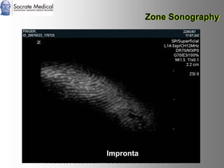 Socrate Medical presenta Zone Sonography, by Zonare