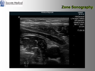 Socrate Medical presenta Zone Sonography, by Zonare