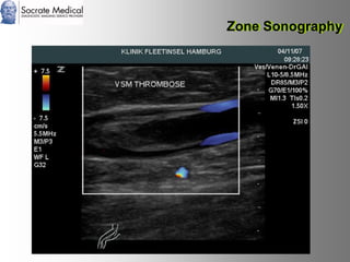 Socrate Medical presenta Zone Sonography, by Zonare