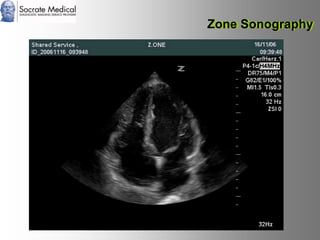 Socrate Medical presenta Zone Sonography, by Zonare