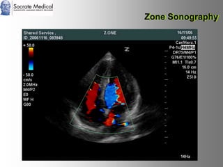 Socrate Medical presenta Zone Sonography, by Zonare