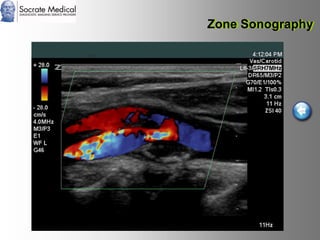 Socrate Medical presenta Zone Sonography, by Zonare
