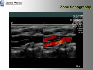 Socrate Medical presenta Zone Sonography, by Zonare