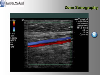 Socrate Medical presenta Zone Sonography, by Zonare