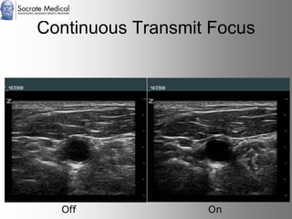 Socrate Medical presenta Zone Sonography, by Zonare