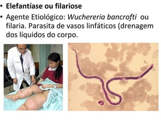 Elefantíase ou filariose Agente Etiológico:  Wuchereria bancrofti   ou filaria. Parasita de vasos linfáticos (drenagem dos líquidos do corpo. 