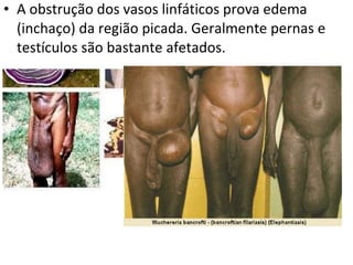 A obstrução dos vasos linfáticos prova edema (inchaço) da região picada. Geralmente pernas e testículos são bastante afetados. 