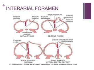 +
INTERARIAL FORAMEN
 