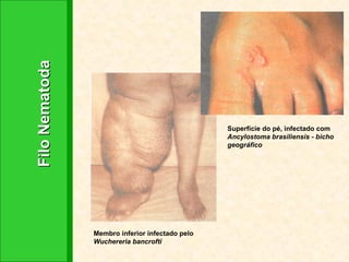 Filo Nematoda Membro inferior infectado pelo  Wuchereria bancrofti Superfície do pé, infectado com  Ancylostoma brasiliensis - bicho geográfico 