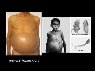 OVOS DE ESQUISTOSSOMO 
CERCÁRIA 
BARRIGA D` ÁGUA OU ASCITE 
 
