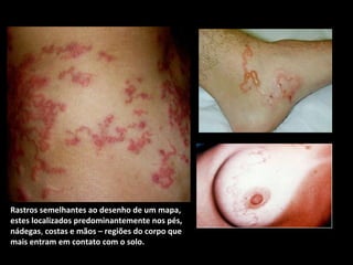 Rastros semelhantes ao desenho de um mapa,
estes localizados predominantemente nos pés,
nádegas, costas e mãos – regiões do corpo que
mais entram em contato com o solo.

 