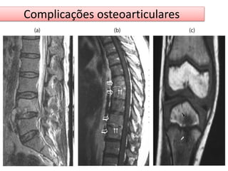 Complicações osteoarticulares 
 
