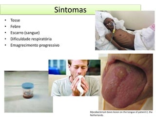 Sintomas 
• Tosse 
• Febre 
• Escarro (sangue) 
• Dificuldade respiratória 
• Emagrecimento progressivo 
Mycobacterium bovis lesion on the tongue of patient 2, the 
Netherlands. 
 