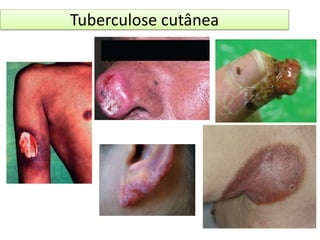 Tuberculose cutânea 
 