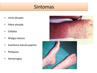Sintomas 
• Início abrupto 
• Febre elevada 
• Cefaléia 
• Mialgia intensa 
• Exantema máculo-papular 
• Petéquias 
• Hemorragias 
 