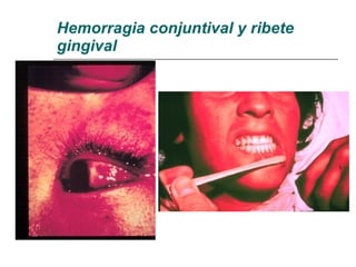 Hemorragia conjuntival y ribete gingival 