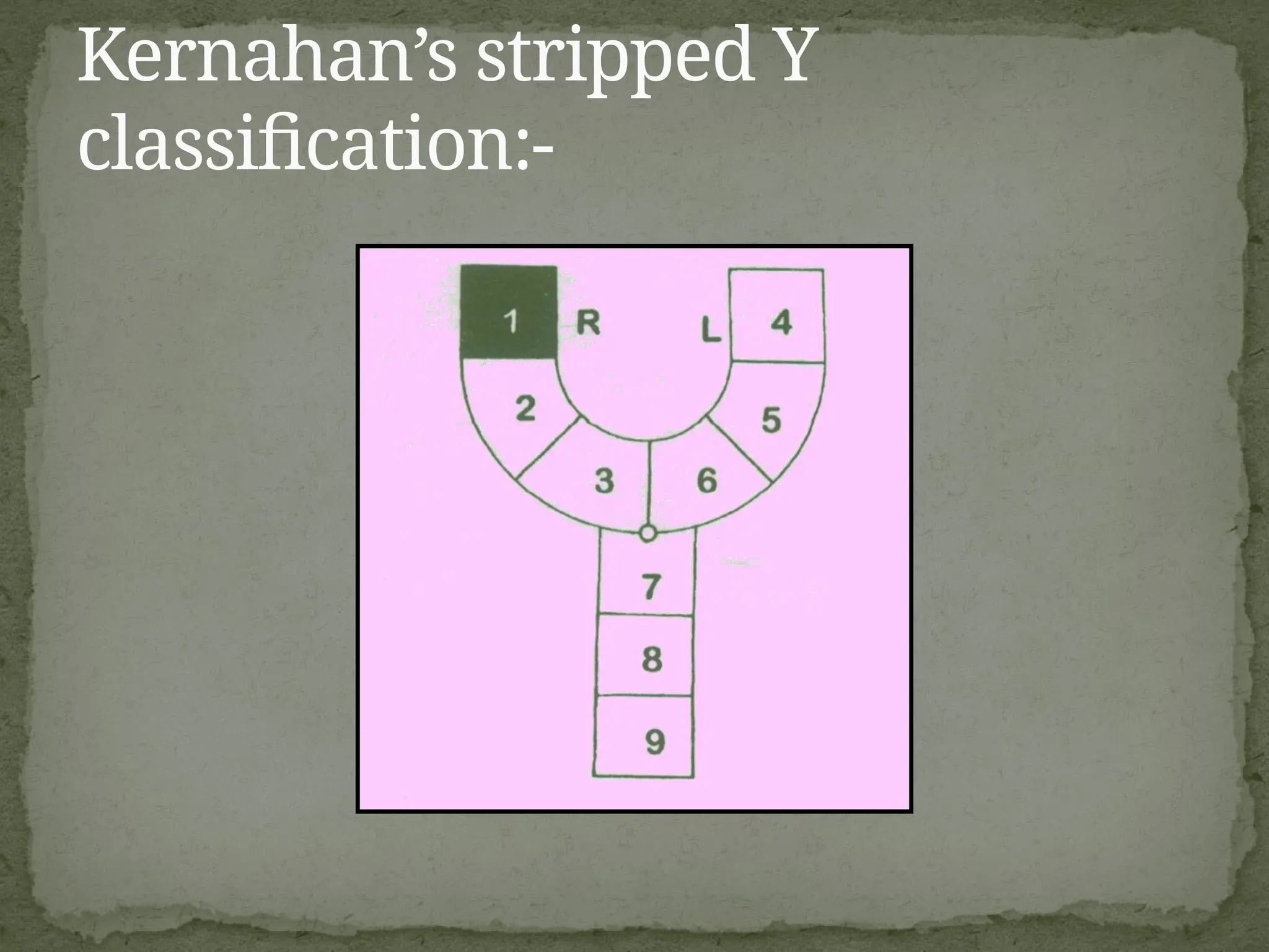 Kernahan’s stripped Y
classification:-
 