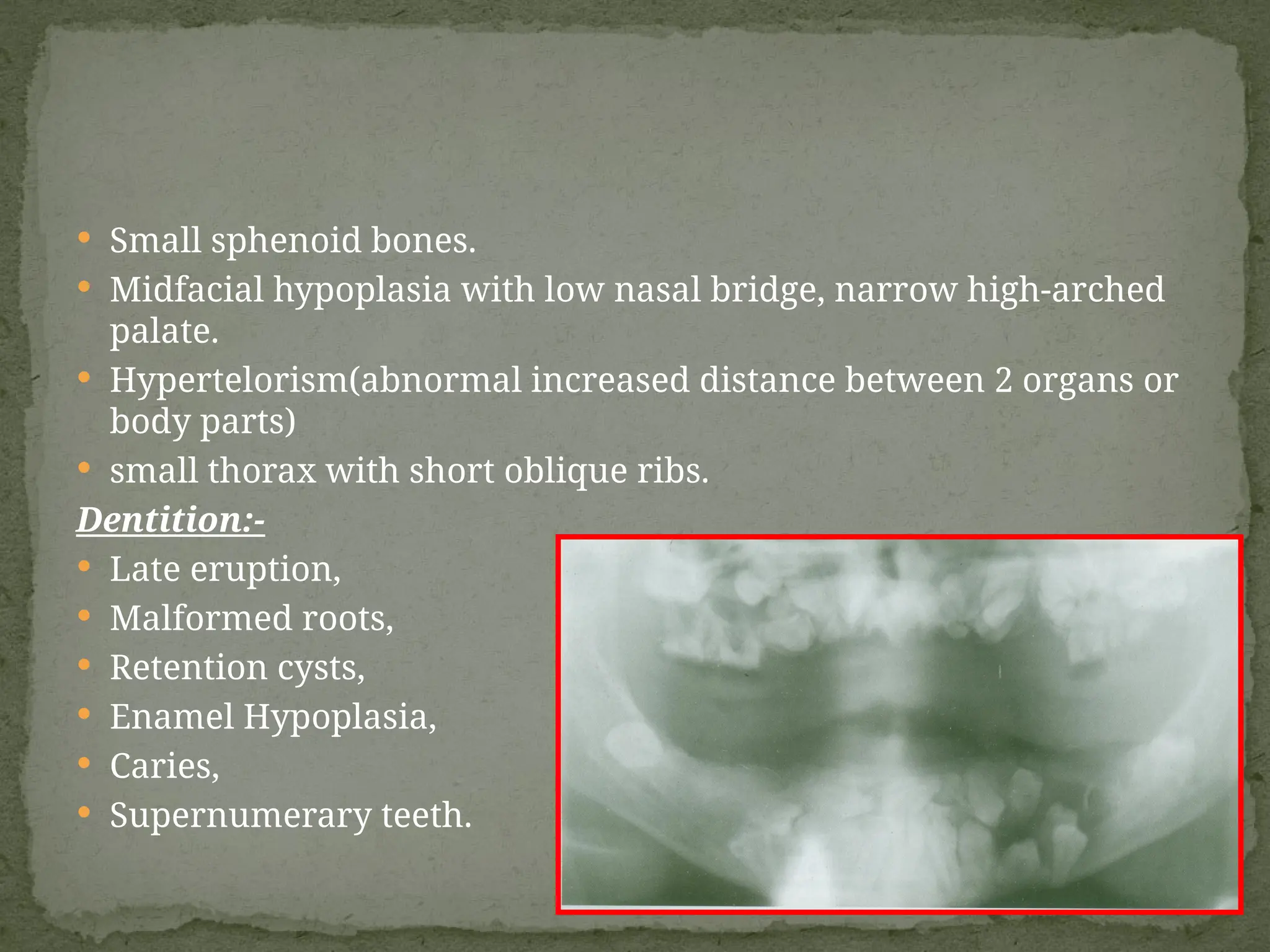 Small sphenoid bones.
 Midfacial hypoplasia with low nasal bridge, narrow high-arched
palate.
 Hypertelorism(abnormal increased distance between 2 organs or
body parts)
 small thorax with short oblique ribs.
Dentition:-
 Late eruption,
 Malformed roots,
 Retention cysts,
 Enamel Hypoplasia,
 Caries,
 Supernumerary teeth.
 