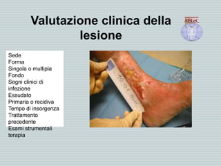 Valutazione clinica della
lesione
Sede
Forma
Singola o multipla
Fondo
Segni clinici di
infezione
Essudato
Primaria o recidiva
Tempo di insorgenza
Trattamento
precedente
Esami strumentali
terapia
 