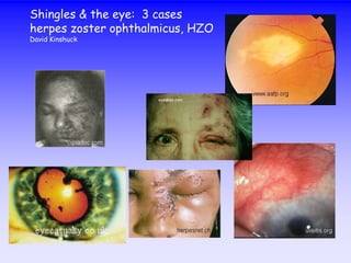 Shingles & the eye: 3 cases
herpes zoster ophthalmicus, HZO
David Kinshuck
 
