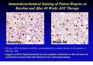 Immunohistochemical Staining of Patient Biopsies at
        Baseline and After 48 Weeks ADV Therapy




    Baseline                                       Week 48
• 0.8 log10 (84%) decline in cccDNA, not paralleled by a similar decline in the number of
  HBcAg+ cells
• Suggests cccDNA depleted primarily by non-cytopathic mechanisms or that cell turn-over
  occurred but was associated with infection of new cells during therapy
 