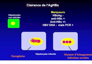 Clairance de l’AgHBs

                               Marqueurs
Hépatocytes                     HBsAg -
non infectés
                               anti-HBc +
                              Anti-HBs +/-
                          HBV DNA - mais PCR +




                    Hépatocytes infectés   Mutants d’échappement
  Oncogénèse
                                             Infections occultes
 