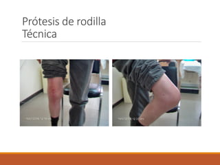 Artroplastía de rodilla | PDF