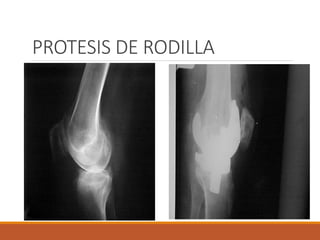 Artroplastía de rodilla | PDF