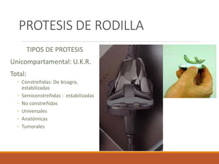 Artroplastía de rodilla | PDF