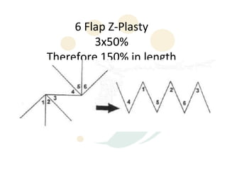6 Flap Z-Plasty
         3x50%
Therefore 150% in length
 