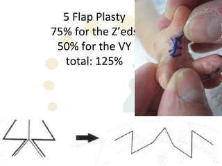 5 Flap Plasty
75% for the Z’eds
 50% for the VY
  total: 125%
 