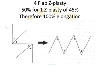 4 Flap Z-plasty
 50% for 1 Z-plasty of 45%
Therefore 100% elongation
 