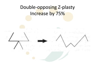 Double-opposing Z-plasty
   Increase by 75%
 