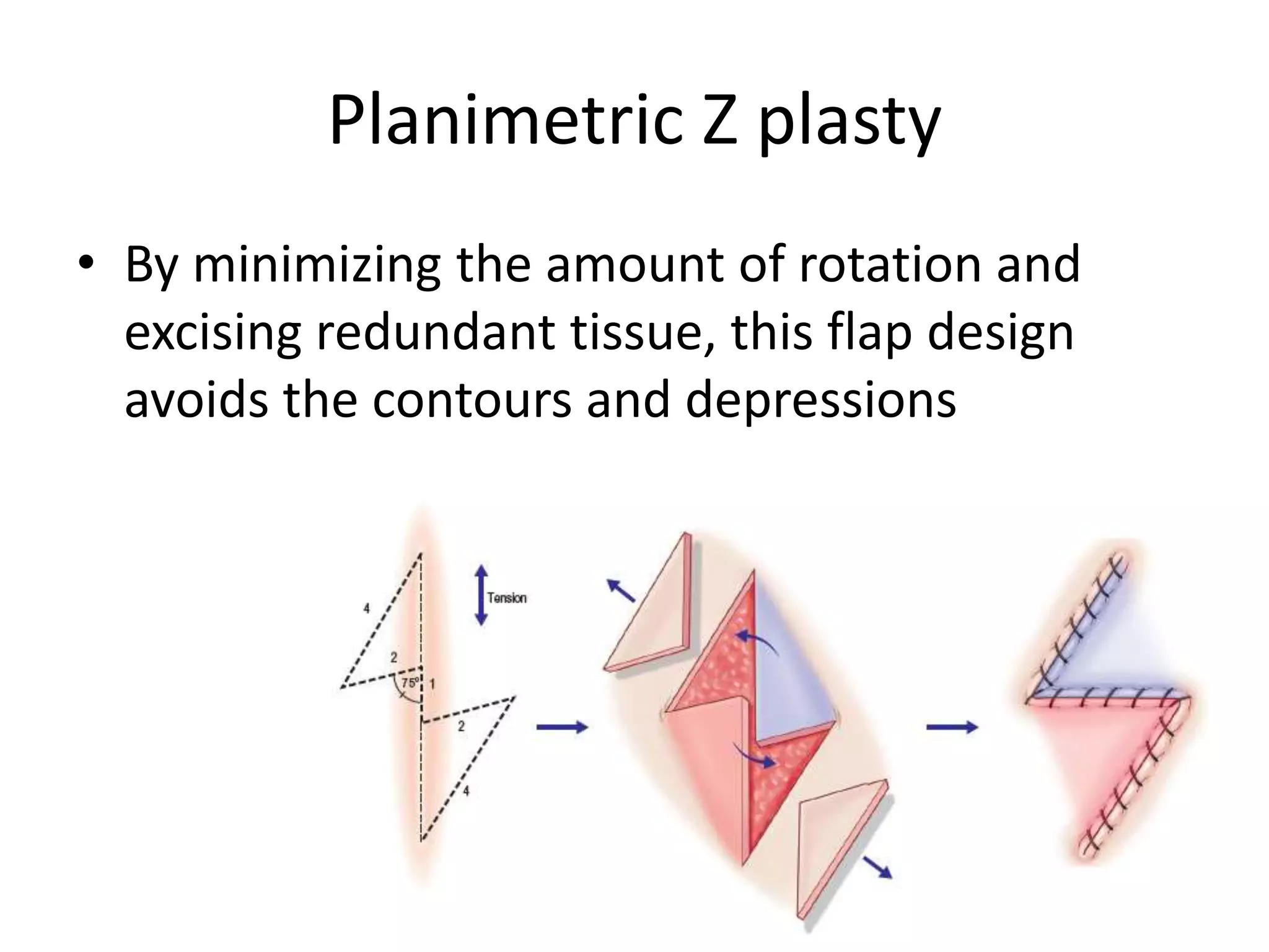 Scar Contracture Example Z plasty in scar contracture release | PPTX