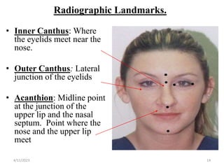 Radiographic Landmarks.
• Inner Canthus: Where
the eyelids meet near the
nose.
• Outer Canthus: Lateral
junction of the eyelids
• Acanthion: Midline point
at the junction of the
upper lip and the nasal
septum. Point where the
nose and the upper lip
meet
4/11/2023 14
 