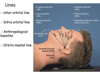 Lines
ne
Inter orbital line
Infra orbital line
Anthropological
baseline
Orbito meatal line
liba
s
eli
ne
 