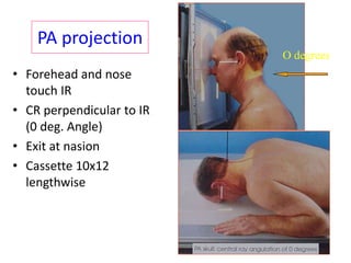 PA projection
• Forehead and nose
touch IR
• CR perpendicular to IR
(0 deg. Angle)
• Exit at nasion
• Cassette 10x12
lengthwise
O degrees
 