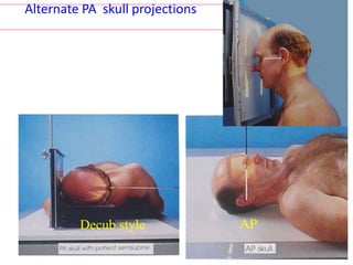 Alternate PA skull projections
Decub style AP
 