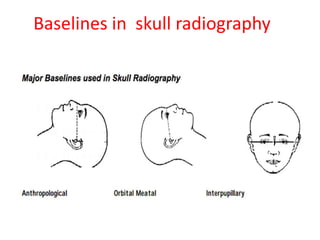 Baselines in skull radiography
 