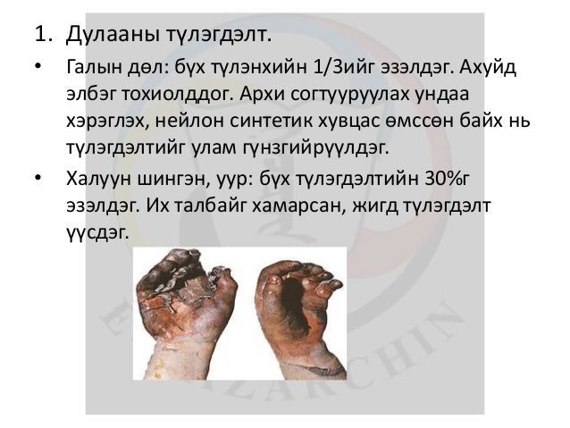 лекц 13 түлэгдэлт, авах арга хэмжээ
