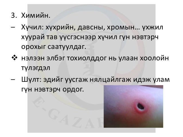 лекц 13 түлэгдэлт, авах арга хэмжээ