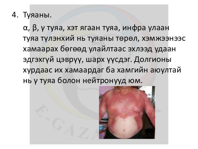 лекц 13 түлэгдэлт, авах арга хэмжээ