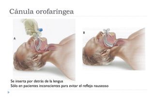 Cánula orofaríngea
Se inserta por detrás de la lengua
Sólo en pacientes inconscientes para evitar el reflejo nauseoso
 